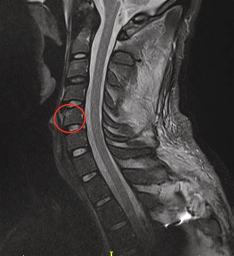 limbus vertebra cervical spine.